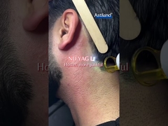 ليزر الديود مقابل ليزر الـ (إند ياغ) ، أيهما تفضله؟